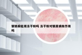 銀銷癬能用凍干粉嗎 凍干粉對銀屑病有作用嗎