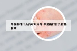 牛皮癬打什么藥可以治療 牛皮癬打什么針最有效
