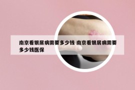 南京看銀屑病需要多少錢 南京看銀屑病需要多少錢醫(yī)保