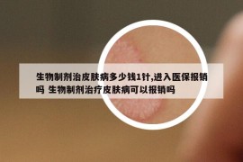 生物制劑治皮膚病多少錢1針,進(jìn)入醫(yī)保報(bào)銷嗎 生物制劑治療皮膚病可以報(bào)銷嗎