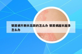 銀屑病不斷長出新的怎么辦 銀屑病越長越多怎么辦