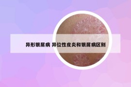 異形銀屑病 異位性皮炎和銀屑病區(qū)別