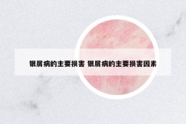 銀屑病的主要損害 銀屑病的主要損害因素