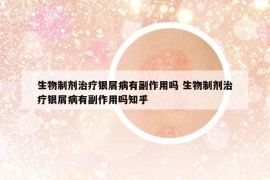 生物制劑治療銀屑病有副作用嗎 生物制劑治療銀屑病有副作用嗎知乎