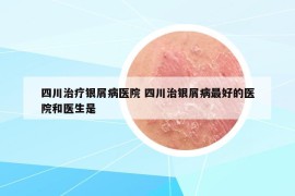 四川治療銀屑病醫(yī)院 四川治銀屑病最好的醫(yī)院和醫(yī)生是