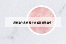 犀角治牛皮癬 犀牛角能治銀屑病嗎?