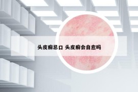 頭皮癬忌口 頭皮癬會自愈嗎