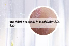 銀屑病治療不見效怎么辦 銀屑病久治不愈怎么辦