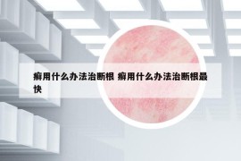 癬用什么辦法治斷根 癬用什么辦法治斷根最快