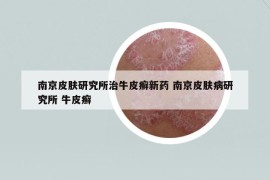 南京皮膚研究所治牛皮癬新藥 南京皮膚病研究所 牛皮癬