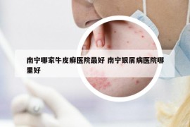 南寧哪家牛皮癬醫(yī)院最好 南寧銀屑病醫(yī)院哪里好