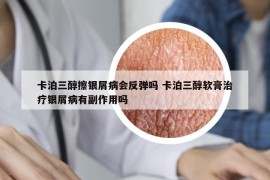 卡泊三醇擦銀屑病會反彈嗎 卡泊三醇軟膏治療銀屑病有副作用嗎