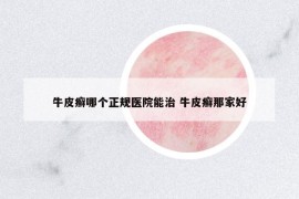 牛皮癬哪個(gè)正規(guī)醫(yī)院能治 牛皮癬那家好