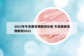 2023年牛皮癬生物制劑價(jià)格 牛皮膚癬生物制劑2021