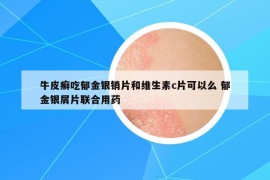 牛皮癬吃郁金銀銷片和維生素c片可以么 郁金銀屑片聯(lián)合用藥