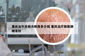 重慶治牛皮癬大概用多少錢 重慶治療銀屑病哪家好