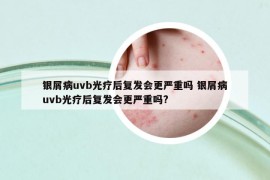 銀屑病uvb光療后復(fù)發(fā)會(huì)更嚴(yán)重嗎 銀屑病uvb光療后復(fù)發(fā)會(huì)更嚴(yán)重嗎?
