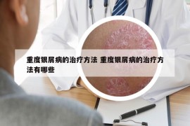 重度銀屑病的治療方法 重度銀屑病的治療方法有哪些
