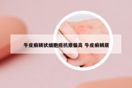 牛皮癬鱗狀細(xì)胞癌抗原偏高 牛皮癬鱗屑