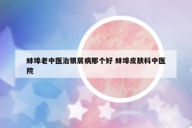 蚌埠老中醫(yī)治銀屑病那個(gè)好 蚌埠皮膚科中醫(yī)院