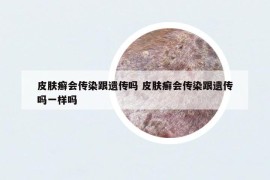 皮膚癬會傳染跟遺傳嗎 皮膚癬會傳染跟遺傳嗎一樣嗎