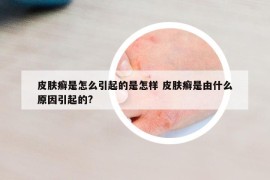 皮膚癬是怎么引起的是怎樣 皮膚癬是由什么原因引起的?