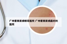 廣州看銀屑病哪家醫(yī)院 廣州看銀屑病最好的醫(yī)院