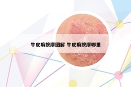 牛皮癬按摩圖解 牛皮癬按摩哪里