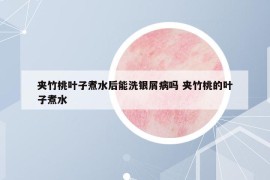夾竹桃葉子煮水后能洗銀屑病嗎 夾竹桃的葉子煮水