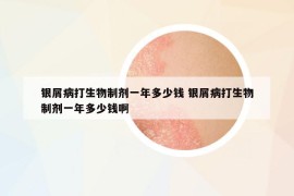 銀屑病打生物制劑一年多少錢 銀屑病打生物制劑一年多少錢啊