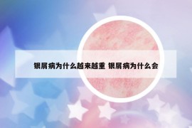 銀屑病為什么越來(lái)越重 銀屑病為什么會(huì)