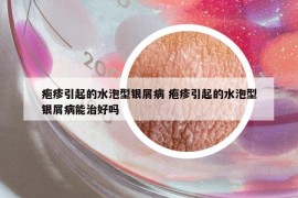 皰疹引起的水泡型銀屑病 皰疹引起的水泡型銀屑病能治好嗎