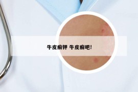 牛皮癬鉀 牛皮癬吧!