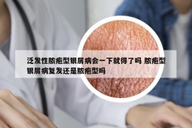 泛發(fā)性膿皰型銀屑病會一下就得了嗎 膿皰型銀屑病復(fù)發(fā)還是膿皰型嗎