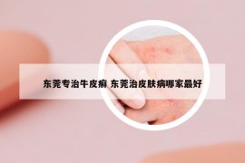 東莞專治牛皮癬 東莞治皮膚病哪家最好