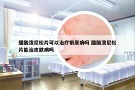 醋酸潑尼松片可以治療銀屑病嗎 醋酸潑尼松片能治皮膚病嗎