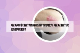臨沂哪家治療銀屑病最好的地方 臨沂治療皮膚病哪里好
