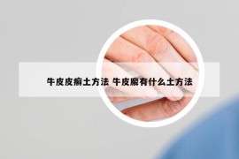 牛皮皮癬土方法 牛皮廨有什么土方法