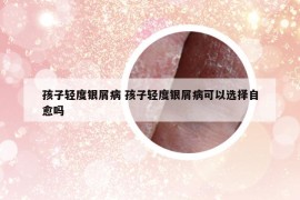 孩子輕度銀屑病 孩子輕度銀屑病可以選擇自愈嗎