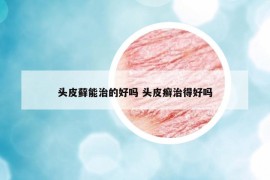 頭皮蘚能治的好嗎 頭皮癬治得好嗎
