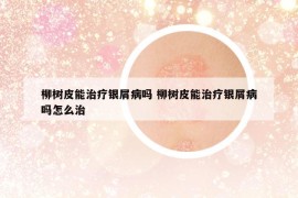 柳樹皮能治療銀屑病嗎 柳樹皮能治療銀屑病嗎怎么治