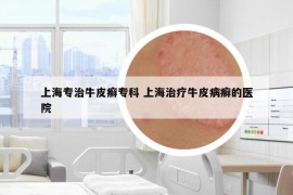 上海專治牛皮癬?？?上海治療牛皮病癬的醫(yī)院