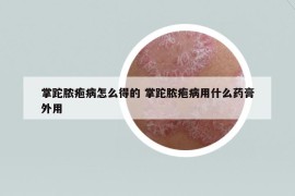 掌跎膿皰病怎么得的 掌跎膿皰病用什么藥膏外用