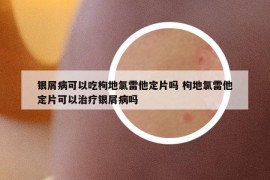 銀屑病可以吃枸地氯雷他定片嗎 枸地氯雷他定片可以治療銀屑病嗎