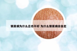 銀屑病為什么總也不好 為什么銀屑病會(huì)自愈