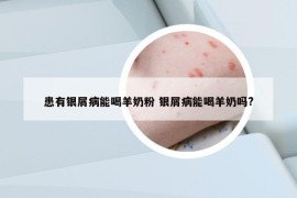 患有銀屑病能喝羊奶粉 銀屑病能喝羊奶嗎?
