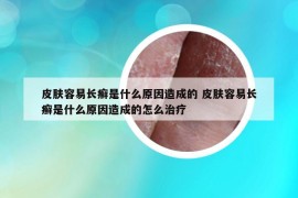 皮膚容易長癬是什么原因造成的 皮膚容易長癬是什么原因造成的怎么治療