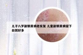 兒子八歲副銀屑病老反復(fù) 兒童副銀屑病留下白斑好多