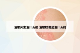 消銀片主治什么病 消銀膠囊是治什么的