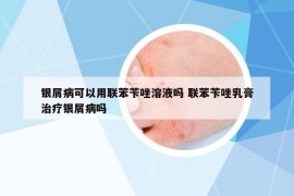 銀屑病可以用聯(lián)苯芐唑溶液?jiǎn)?聯(lián)苯芐唑乳膏治療銀屑病嗎
